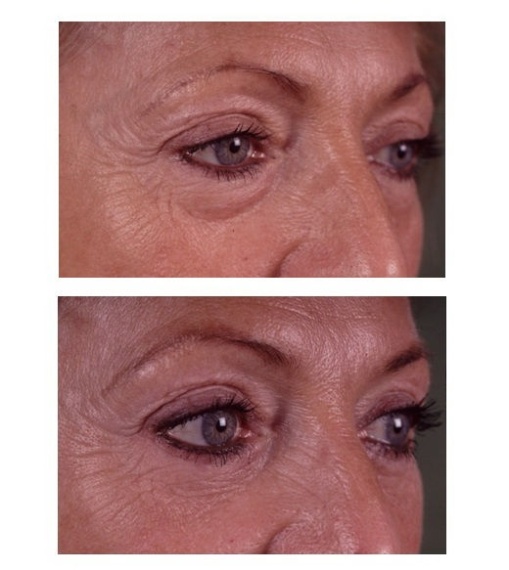 Lower eyelid correction
