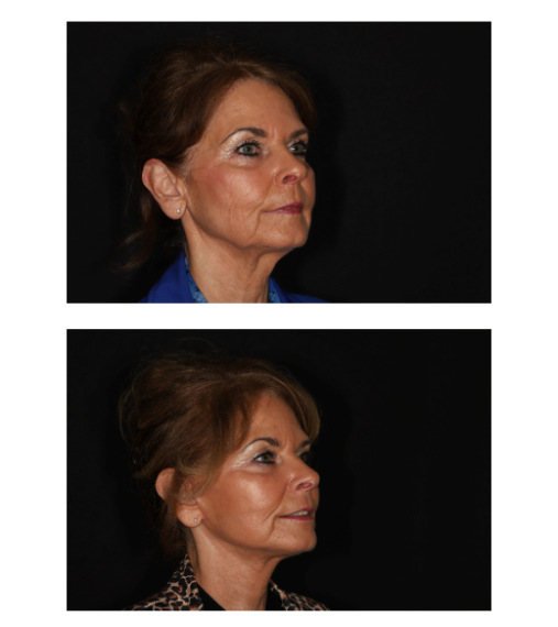 Facelift zijaanzicht (litteken achter de temporale haargrens)