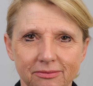 Volume restoration, correction of the jawline and improvement of the skin