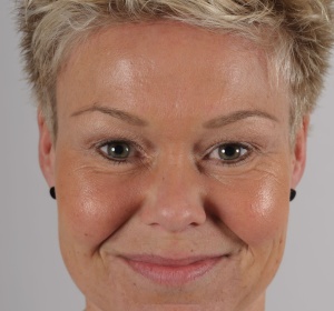 Ook de oogleden verbeteren na een voorhoofdslift Ook de oogleden verbeteren na een voorhoofdslift