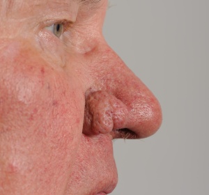 Rhinophyma van de neusvleugels Rhinophyma van de neusvleugels