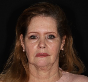 Restoration of volume and improvement of the jawline and the neck