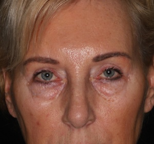 Reduction of the bags of the lower eyelid Reduction of the bags of the lower eyelid