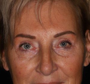 Reduction of the bags of the lower eyelid Reduction of the bags of the lower eyelid