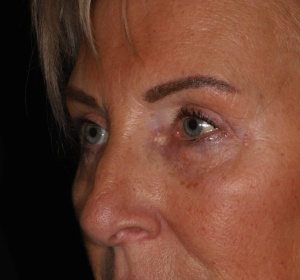 Reduction of the bags of the lower eyelid Reduction of the bags of the lower eyelid