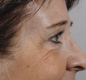 Lateral view of a browlift