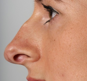 aangeboren onderontwikkeling van linker zijde van de neus (1).jpg