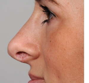 aangeboren onderontwikkeling van linker zijde van de neus (2).jpg