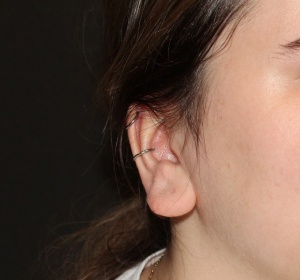 Correction of a protruding earlobe Correction of a protruding earlobe