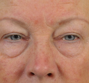 The dark circles are caused by the shadow of the bags in de lower eyelids The dark circles are caused by the shadow of the bags in de lower eyelids