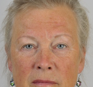 Correction of the upper and lower eyelids Correction of the upper and lower eyelids