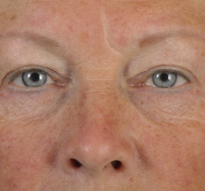 The dark circles are caused by the shadow of the bags in de lower eyelids The dark circles are caused by the shadow of the bags in de lower eyelids