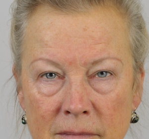 Correction of the upper and lower eyelids Correction of the upper and lower eyelids