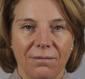 Long-term wear of contact lenses can lead tot ptosis Long-term wear of contact lenses can lead tot ptosis