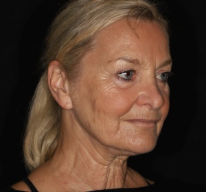 Face- en halslift (1).jpg Face- en halslift (1).jpg