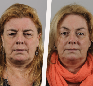 Een facelift in drie stappen Een facelift in drie stappen
