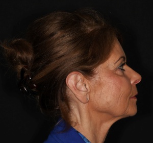 Bij een lage haarimplant kan het litteken niet zichtbaar in de bakkebaard geplaatst worden Bij een lage haarimplant kan het litteken niet zichtbaar in de bakkebaard geplaatst worden