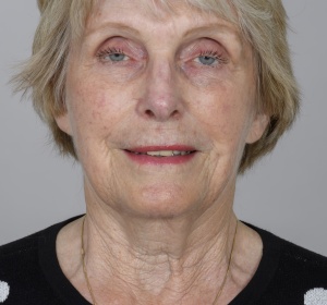 Long-term wear of contact lenses can lead tot ptosis Long-term wear of contact lenses can lead tot ptosis