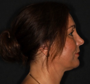Kin vergroting en liposuctie hals (2).jpg Kin vergroting en liposuctie hals (2).jpg