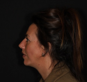 The facial profile is more balanced after the chin implant