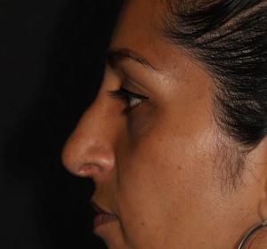 Upward rotation of the drooping nose tip