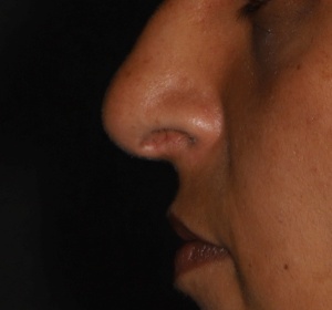 Upward rotation of the drooping nose tip
