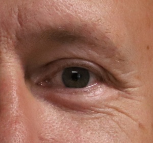Rejuvenation of the eyelid by repositioning of the "lid-cheek junction" Rejuvenation of the eyelid by repositioning of the "lid-cheek junction"