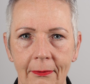 Correction of protruding ears in an adult Correction of protruding ears in an adult