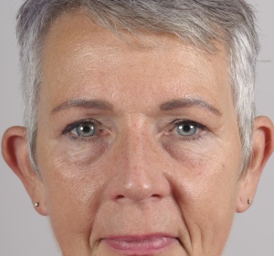 Correction of protruding ears in an adult Correction of protruding ears in an adult