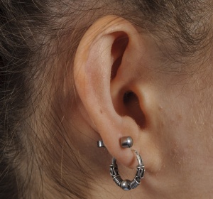Creating the fold of the ear cartilage Creating the fold of the ear cartilage