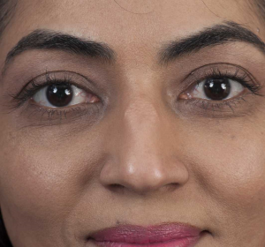 Scherpe randen van de neusrug Scherpe randen van de neusrug