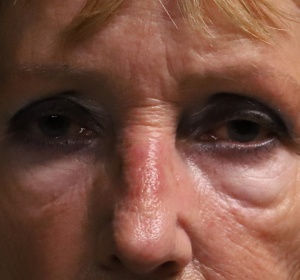 vet verwijderen en verplaatsen via de buitenzijde van de onderoogleden (2).jpg