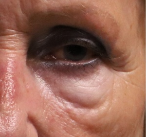 vet verwijderen en verplaatsen via de buitenzijde van de onderoogleden close-up(2).jpg