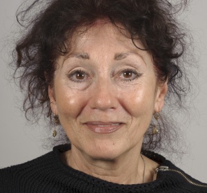 Voorhoofdslift zonder een ooglidcorrectie geeft een natuurlijk resultaat Voorhoofdslift zonder een ooglidcorrectie geeft een natuurlijk resultaat