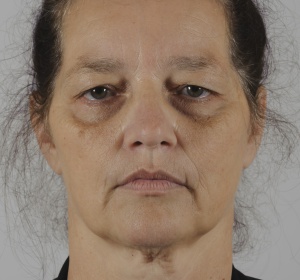 Correction of the upper eyelids only Correction of the upper eyelids only