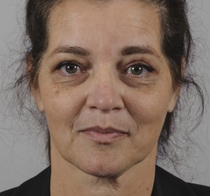 Correction of the upper eyelids only Correction of the upper eyelids only