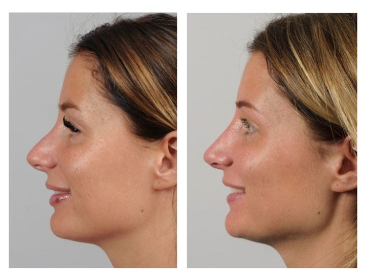 Re-do nose correction, correction of the nasal ridge.