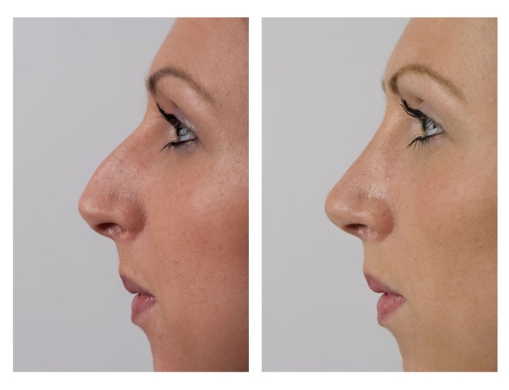 Correction of the nasal ridge.