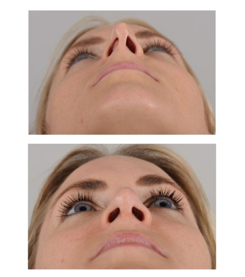 
Nose correction - reduction of the projection of the nose and correction of the tilt of the nasal septum. The nose comes closer to the face, the elongated nostrils relax and become rounder.