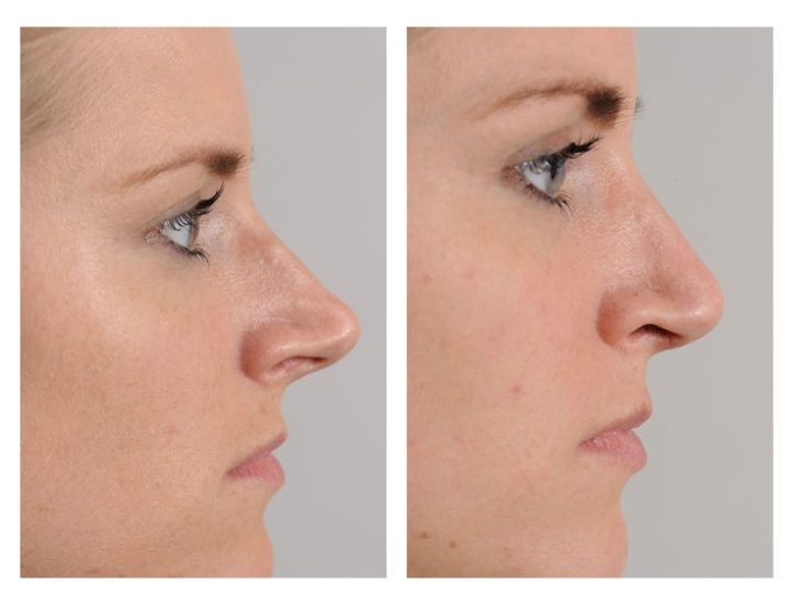 Nose correction. Reduction in projection.
