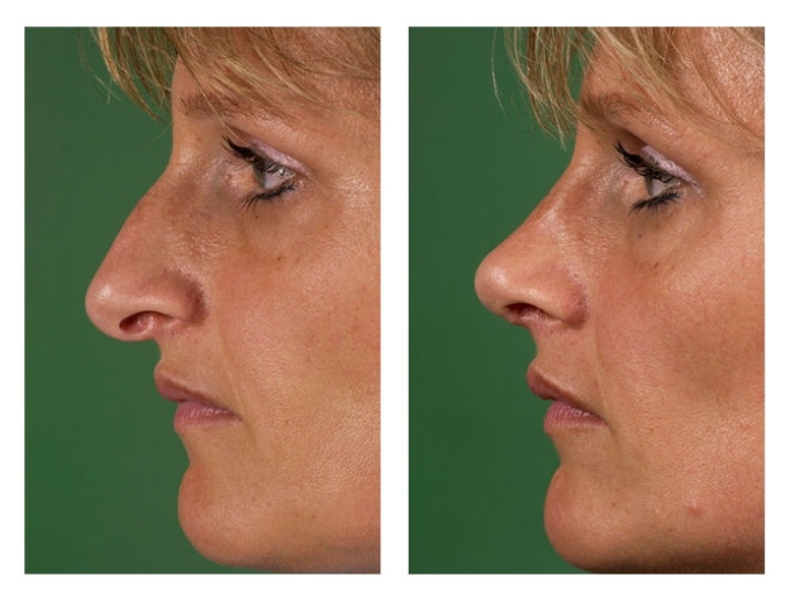 Shorten the nose and upward rotation of the tip.