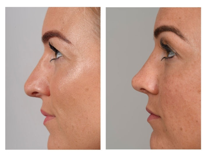 Re-do neuscorrection of the nasal ridge and upward rotation of the nose tip.