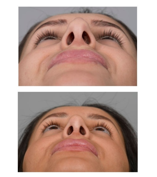 Correction of the nose tip (bottom view).