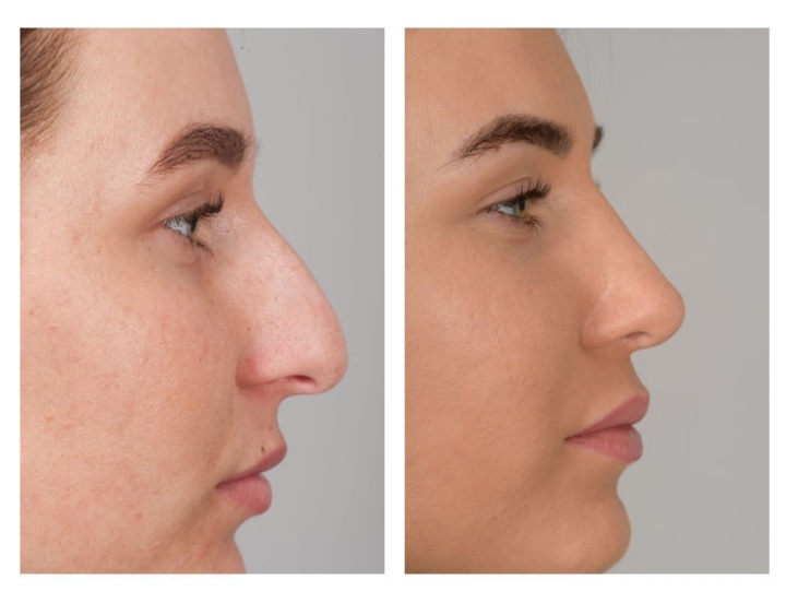 Extensive nose correction of the bone, the nasal septum and the nose tip.