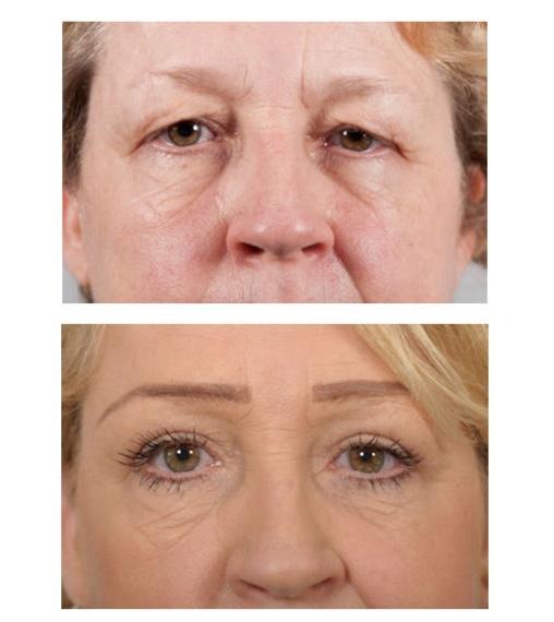 Correctie van de bovenoogleden en Botox behandeling van de fronsrimpels
