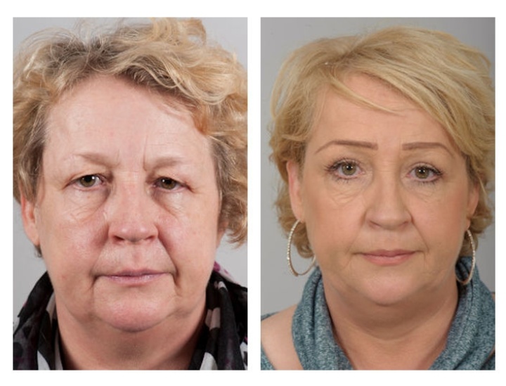 Correctie van de bovenoogleden en Botox behandeling van de fronsrimpels