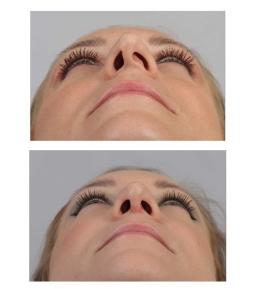 Correction of the tilt of the nasal septum.