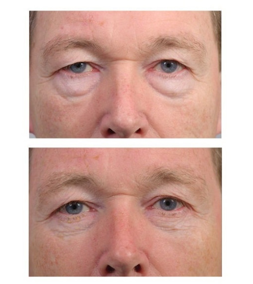 Lower eyelid correction