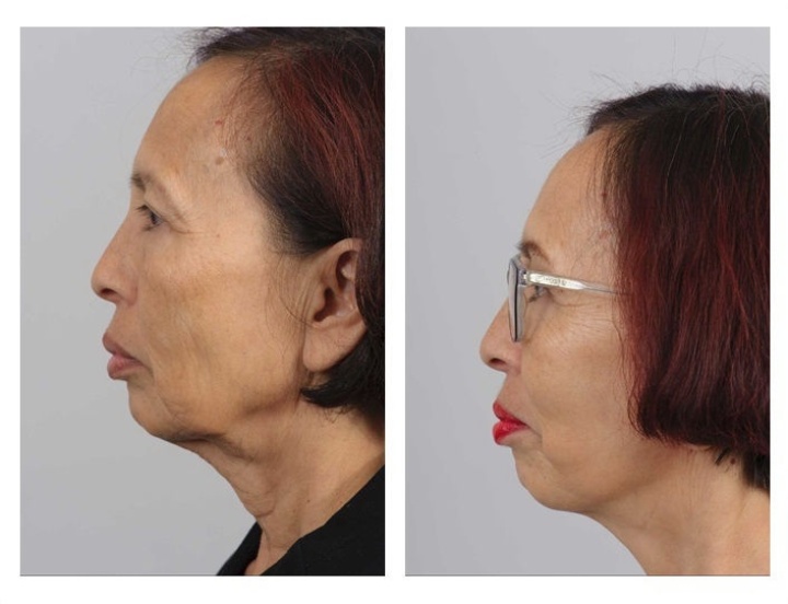 Facelift. The positive effect on the neck is visible too.