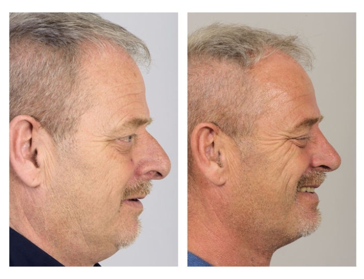 Limited nose correction for men while retaining character.